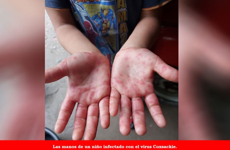 ¡Alerta! Virus Coxsackie se está propagando en jardines de niños